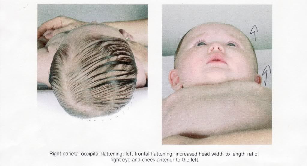 New hereDoes she need a helmet? UPDATE BabyCenter