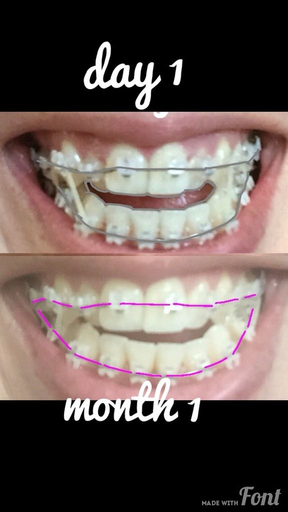braces crossbite teeth misalignment crowding mouth openbite ongoing journal pretty metal