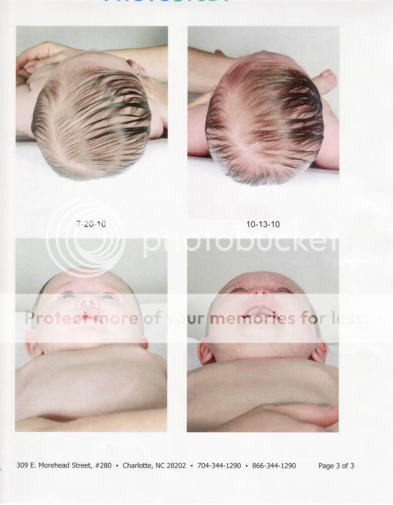 New hereDoes she need a helmet? UPDATE Page 2 BabyCenter